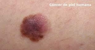 EXPOSICIÓN Comité Internacional de proteccion radiologica