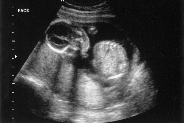 Found out I was pregnant