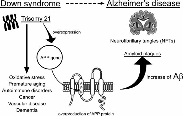 Alzheimer's and Down Syndrome linked