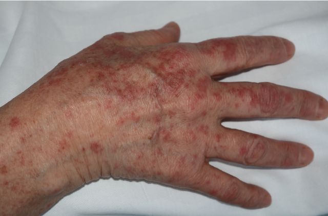 Comité internacional de protección radiológica - Evento 3