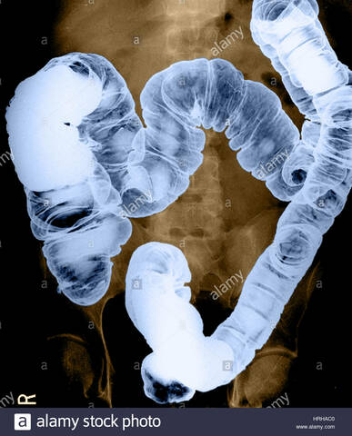 enema doble contraste