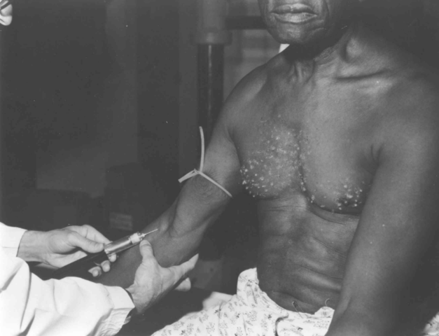 Experimento de Tuskegee, Alabama