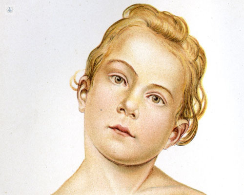 En 1873 acuñó la denominación “tortícolis”, en referencia al “tortícolis ocular”.