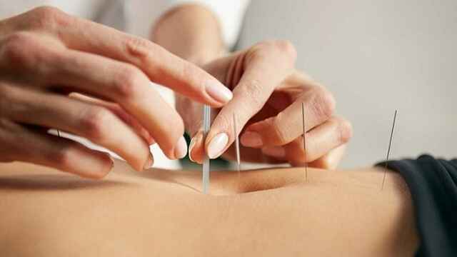 Acupuntura