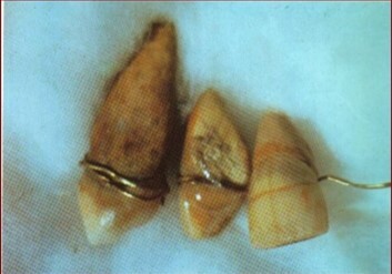 Año 200 A.C: Prótesis egipcia.