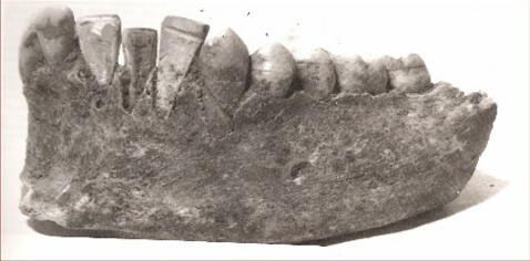 Año 600: Prótesis con una concha