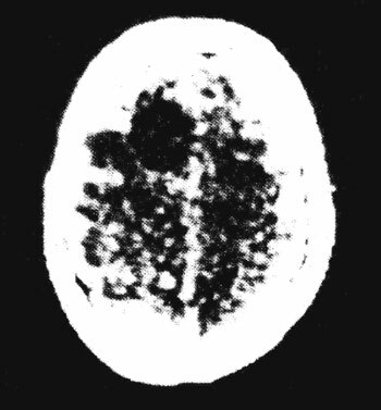 Se instaló el primer prototipo de escáner cerebral EMI MARK I, con el que se obtuvo la primera TAC cráneo-encefálico en el Hospital atkinson morley.