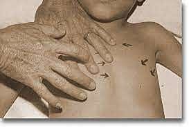 Descubrimiento de la percusión con fines médicos