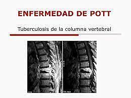 Descripción de tuberculosis espinal