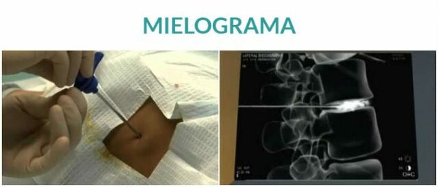 La mielografia
