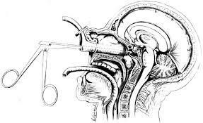 La cirugía mínimamente invasiva. Jules Hardy