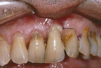 Bacterias Periodontales