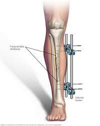 broke my leg into 3 peaces