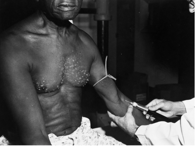 Tuskegee Syphilis Study