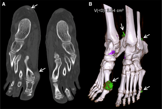 Lesiones musculoesqueléticas