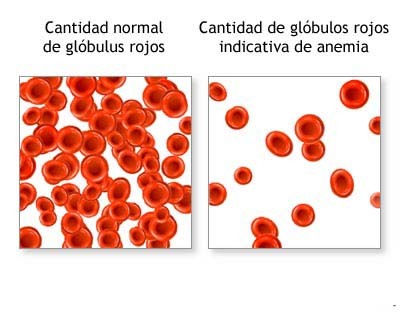 Anemia