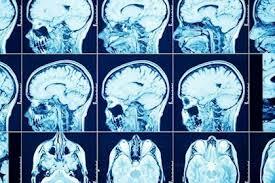 Creación de Imágenes Cerebrales