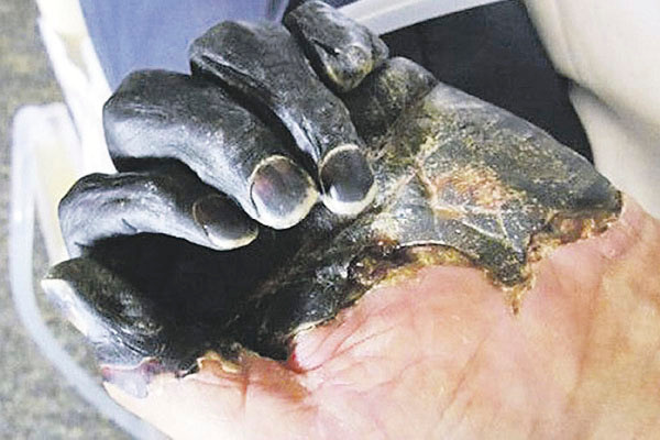 Síntomas y variantes