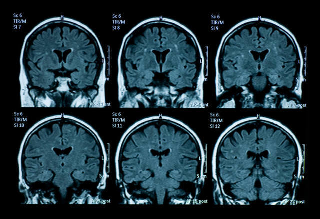 Crecimiento de la Neuropsicología