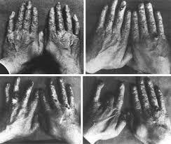 Clarence Dally muere debido a la exposición a la radiación