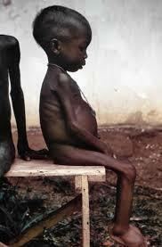 Enfermedad de "Kwashiorkor"