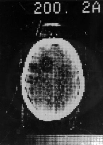 Primera tomografía computada