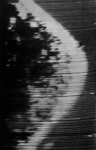 Primera ecografía de mama