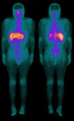 Aplicación de la gammagrafía