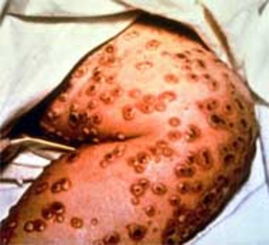 Smallpox Epidemic