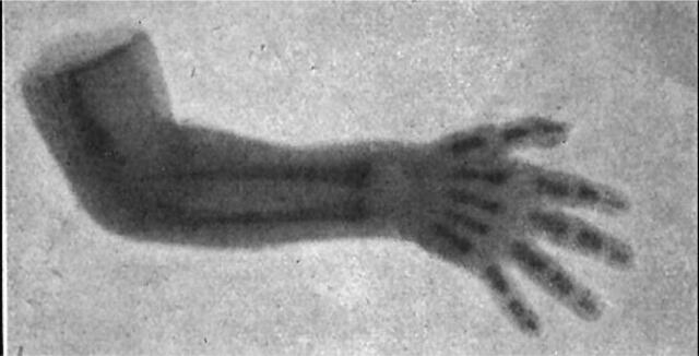 Radiografía de un brazo fracturado