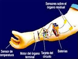 Prótesis mioeléctrica.