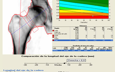 Se descubre la densimetría ósea.