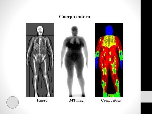Dual-energy X-ray absorptiometry, DXA