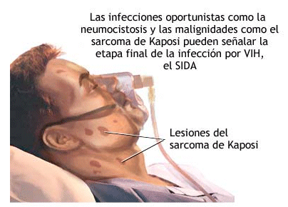 VIRUS DE INMUNODEFICIENCIA ADQUIRIDA (VIH)