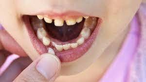 LE TIRARON UN DIENTE DE LECHE