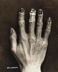 Claurence Dally muere debido a la exposición a la radiación.