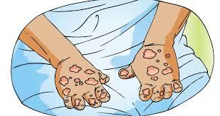 Servicio de Rehabilitación de profilaxia de la Lepra