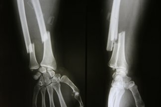 El primer brazo roto