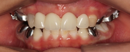 Problemas en los dientes (Pasado)