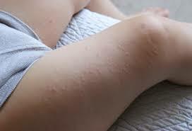 Mi primera reacción alérgica al sol