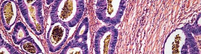 Nueva inmunoterapia contra el cáncer "pembrolizumab "