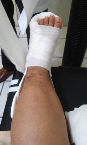 Me esguince el tobillo