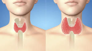 Primer programa de iodación de la sal