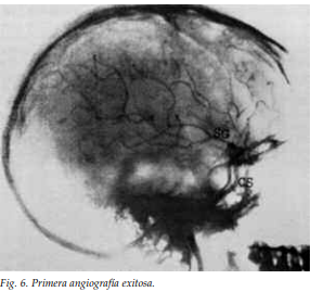 Primera angiografía