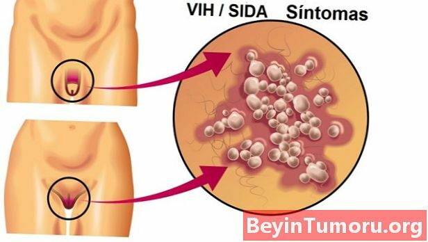 Virus de Inmunodeficiencia Adquirida (VIH)
