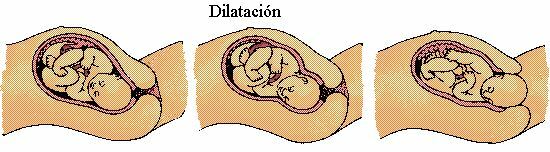 DILATACIÓN