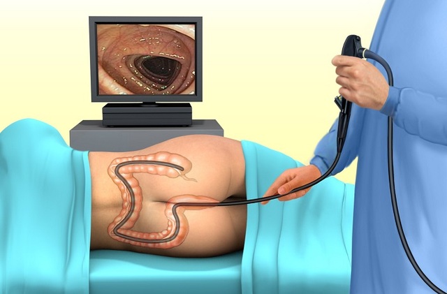 Colonoscopy