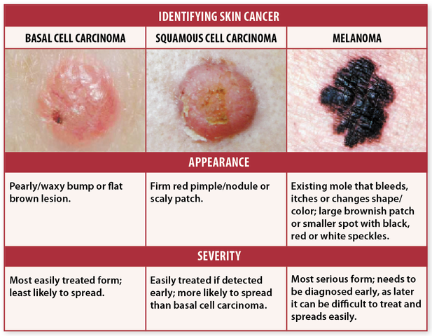 Skin cancer self exam