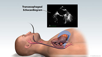 Transesophageal Echocardiogram (TEE)