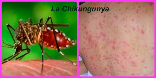 Fiebre chikungunya